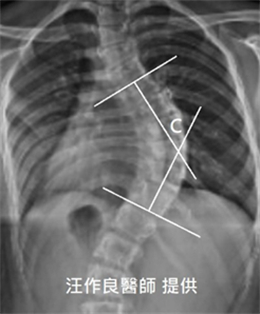 10月13日-早期-復康資訊1-及早發現把握治療期!居家檢查孩子是否有脊椎側彎症狀-梁愛麗2.jpg